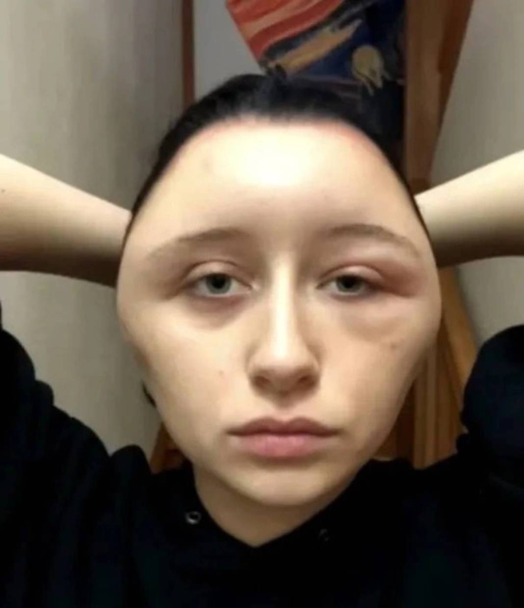 Marketten aldığı ürünle saçını boyadı: Kafası ampul gibi şişti! Yakınları bile tanıyamadı 2